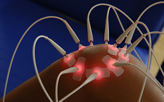Needleless Laser Acupuncture